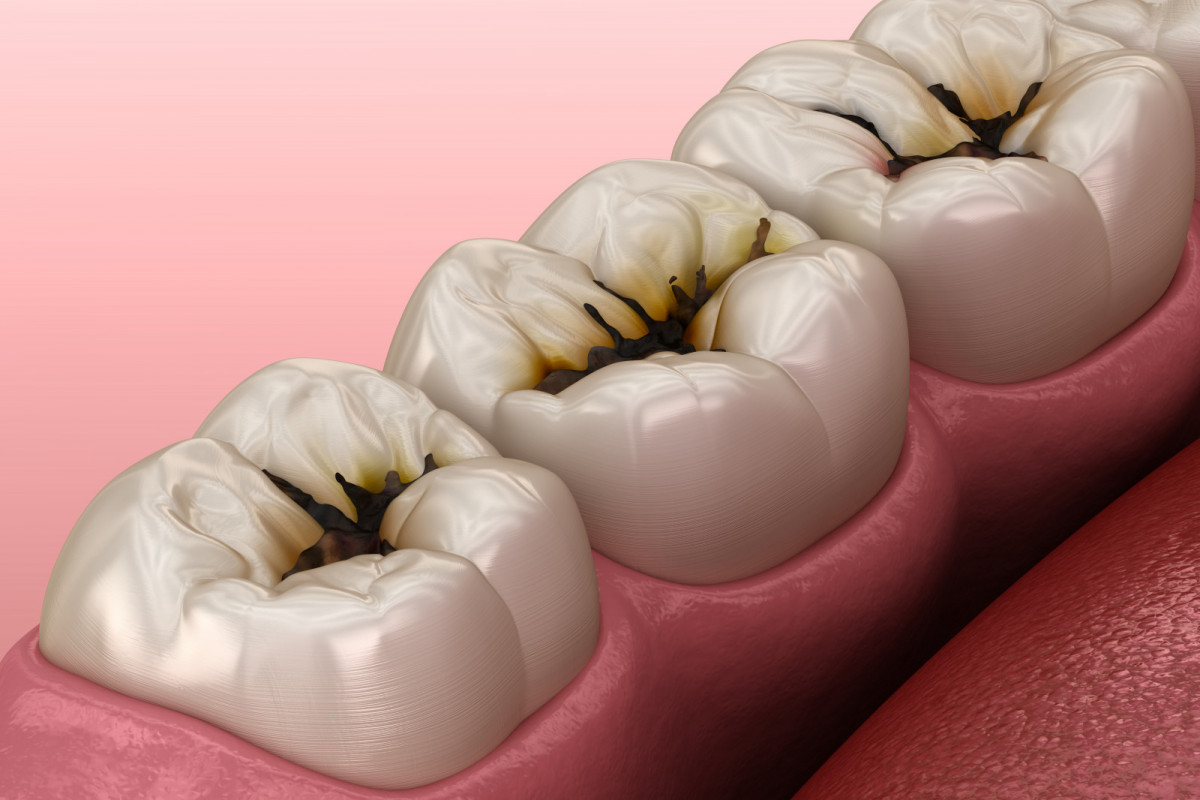 ¿qué son las caries dentales?
