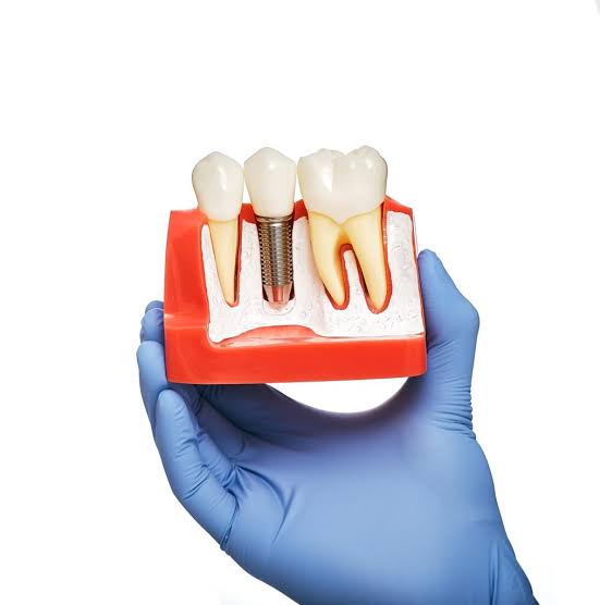 ¿Qué hacer para que los implantes duren toda la vida?